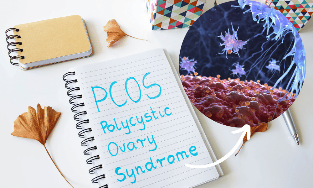 Is PCOS an Autoimmune Disease