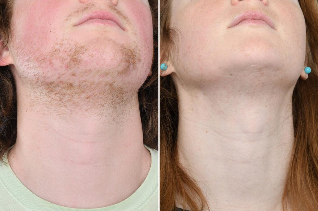 Results of Electrolysis