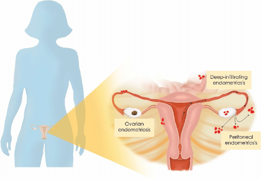 Types and stages of endometriosis