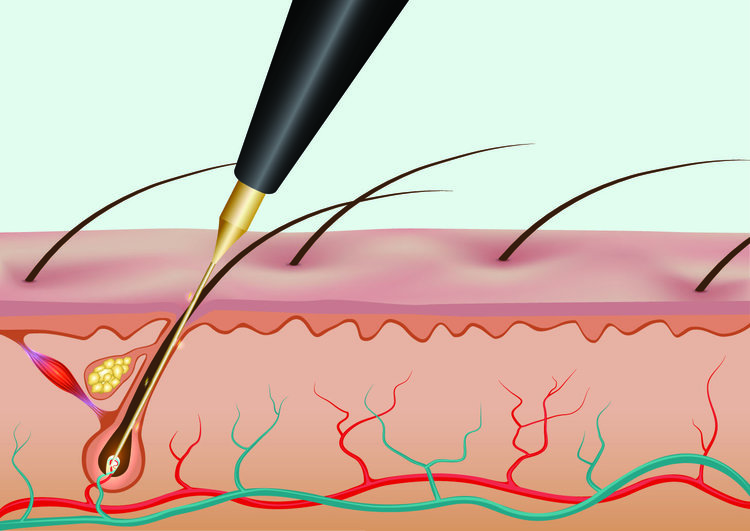 How does electrolysis work?