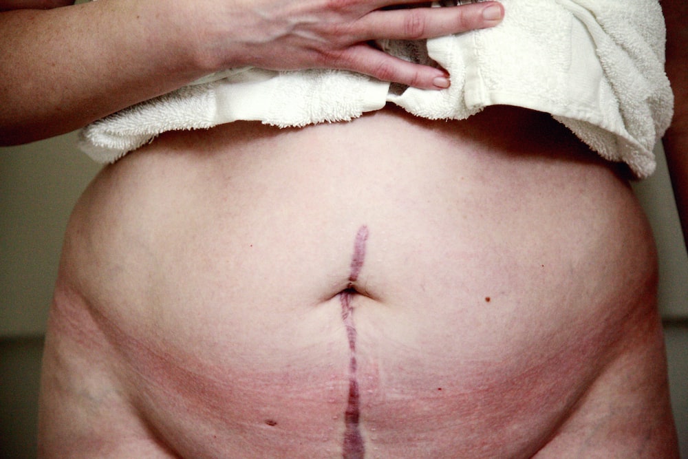Lower Back Pain After a C-Section
