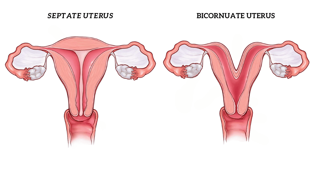 Bicornuate Uterus vs Septate Uterus