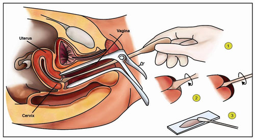 How Pap Smears Detect Abnormalities