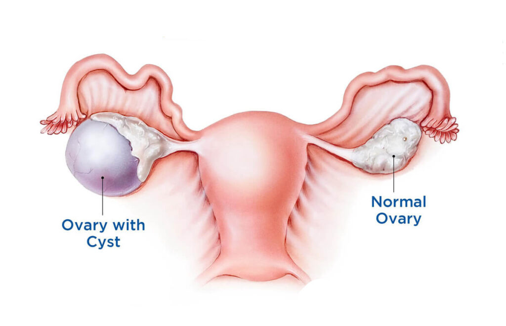 Relationship Between Ovarian Cysts and Pap Smears
