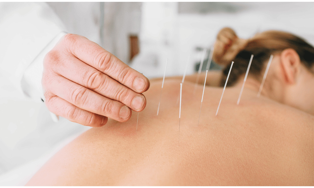 Does Acupuncture Help PCOS